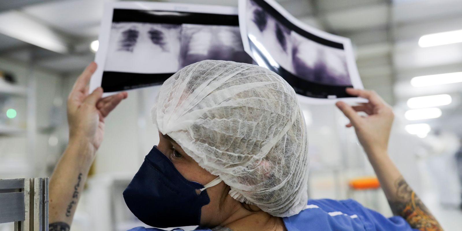 brasil-deve-ter-781-mil-novos-casos-de-cancer-por-ano-ate-2028