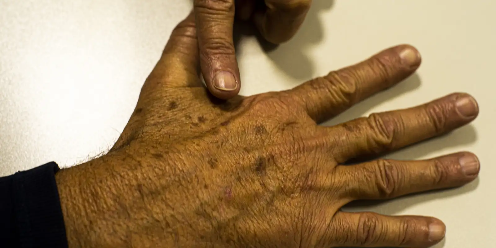 desinformacao-sobre-cancer-de-pele-afeta-diagnostico,-diz-instituicao